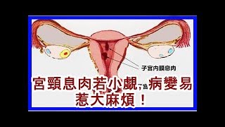 宮頸息肉若小覷，病變易惹大麻煩！