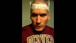 Hair transplant; FUE vs FUT