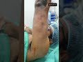 Lipoma Removal