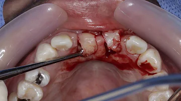 ¿Qué es la fase 2 de un implante dental?