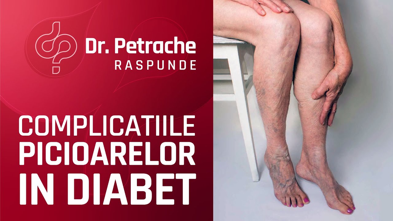 Afla CUM iti AFECTEAZA Diabetul PICIOARELE