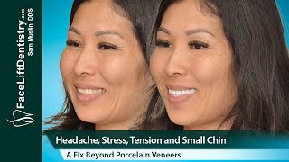 Worn Down Teeth, Aging Face, Sinking Jawline, 8-Day Fix