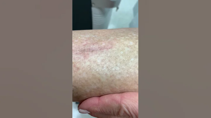 Scar Revision Fractionated CO2 treatment. Dr Mahol...