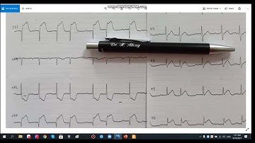Hướng Dẫn Đọc ECG Nhồi máu cơ tim STEMI