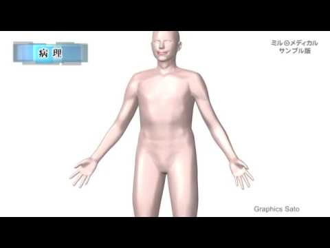 肺サルコイドーシス／2分で分かる医療動画辞典　ミルメディカル
