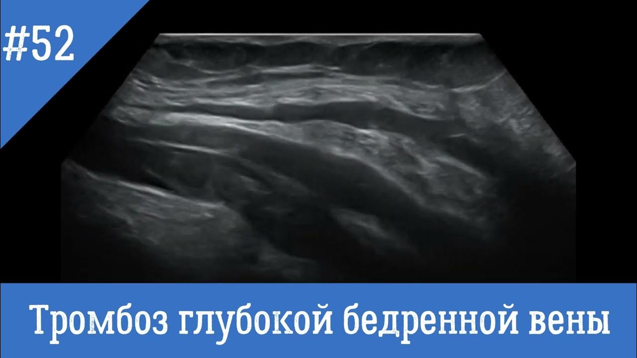 Узи вен тромбоз. Тромбофлебит глубоких вен УЗИ. Флеботромбоз глубокой бедренной вены. Тромбоз бедренной вены на УЗИ.