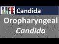 Oropharyngeal candida