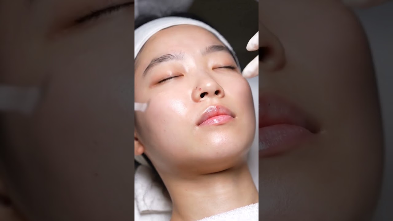 “Most Satisfying Blackhead Removal Ever (ASMR)”