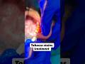 Tobacco Sustains Treatment At Aayat clinic shamli #shorts #dental #dentalcare #viral #reels