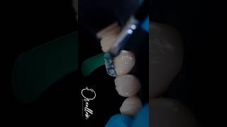 Dental motivation. Direct composite restoration teeth. Composite veneers #veneers #dentistry