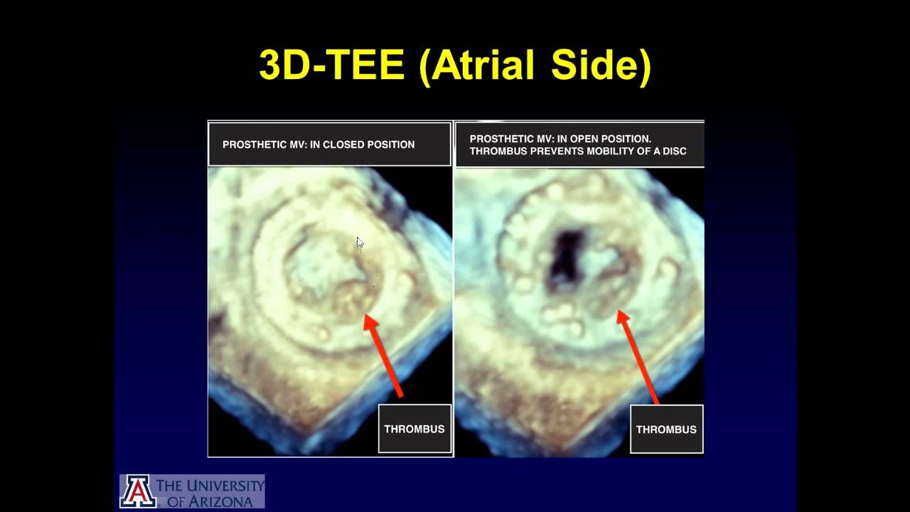 Prosthetic Mitral Valve Obstruction: Accurate Diagnosis by 3D
