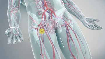 TAVR Patient Procedural Animation Final