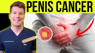 Doctor explains PENIS CANCER | Symptoms, causes and treatment