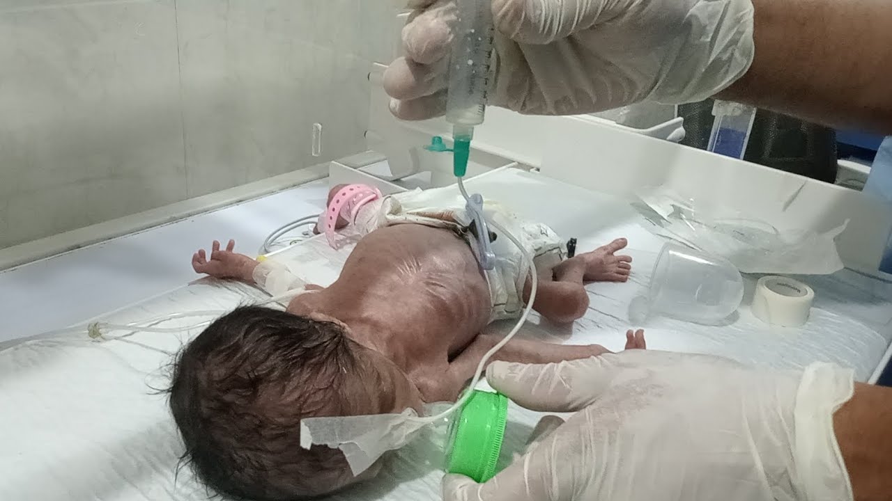 👶 Newborn Premature Baby N/G Feeding Procedure | NICU Male Nurse Care in Incubator