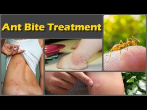 How To Get Rid Of Ant Bite And Top 10 Natural Home Remedies For Ant Bites