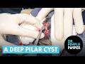 A Deep Pilar Cyst