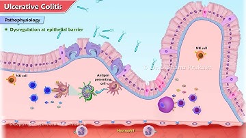 Ulcerative Colitis Animation : Etiology, Clinical features, Pathophysiology, Diagnosis, Treatment