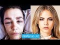 Teen Ruins Face To Look Like Cara Delevingne