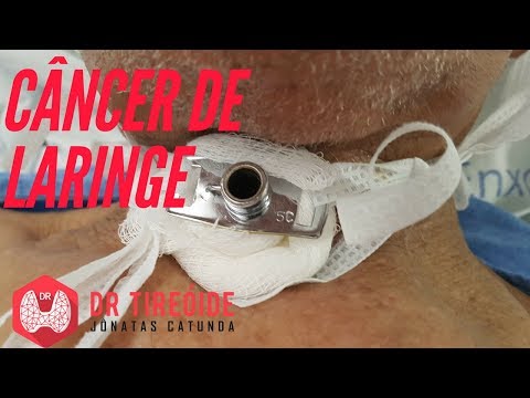 Vídeo: Os cânceres de laringe são comuns?