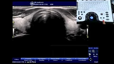 NextGen LOGIQ e: Split Screen