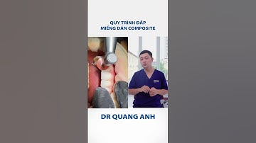 Phương pháp phục hình thẩm mỹ răng tiết kiệm chi phí | Nha Lhoa ViDental #nhasi #composite #tramrang