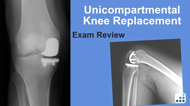 Unicompartmental Knee Replacement Exam Review - Ma...