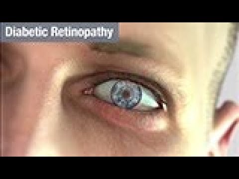 An Overview of Diabetic Retinopathy