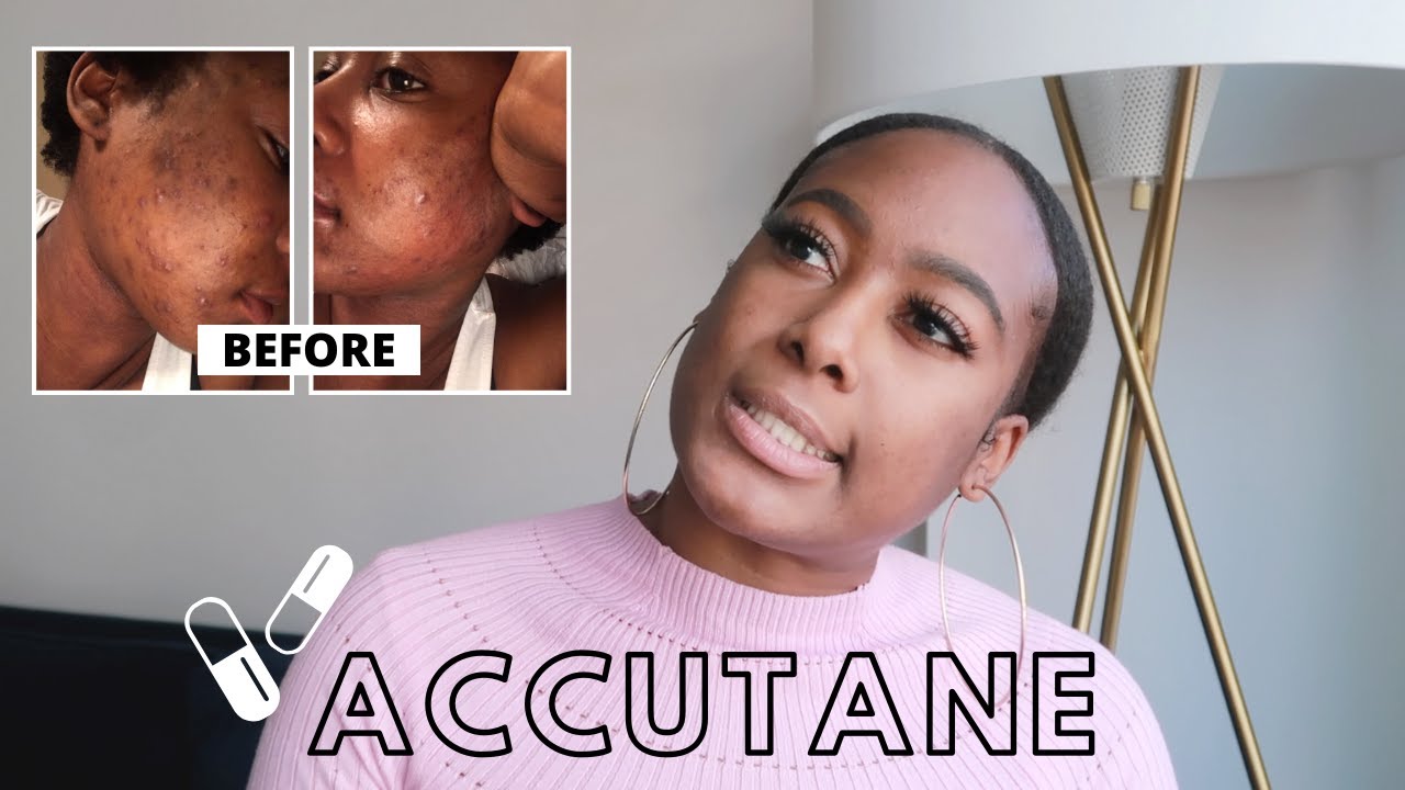 My Accutane Journey: 4 Step Skincare Routine + Easy Tips - YouTube