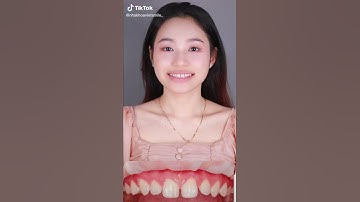 Răng thưa có dán sứ veneer được không? #shorts #dansuveneer #rangthua