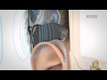 Electric Acoustic Stimulation (EAS) Hearing Implant System Video | MED-EL(Aud. Tewfiq Siliman Herini… Erbil-Kurdistan tewfiqsiliman@yahoo.com... 009647504485973)