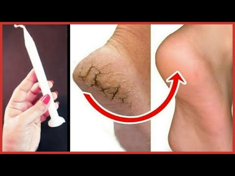 Remove Cracked Heels and Get Beautiful Feet - Magical Cracked Heels Home Remedy | Telugu health tips