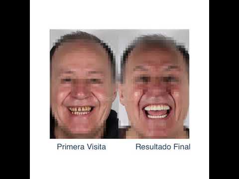Eliminamos los focos