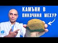 Камъни в Пикочния Мехур - Как и Защо се Образуват?!