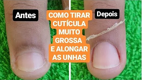 Como eliminar cutículas grossas?