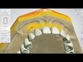 Dental lab life designing a denture using 3shape