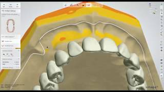 Dental Lab Life: Designing a Denture Using 3Shape