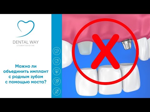 Можно ли сделать мостовидный протез между имплантатом и своими зубами