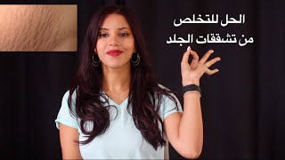 تخلصي من تشققات الجلد الخطوط البيضاء تمدد الجلد بهذه الطرق الطبيعية و السهلة