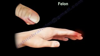 Infection of the finger. what is a felon finger. Diagnosis and treatment of a felon.