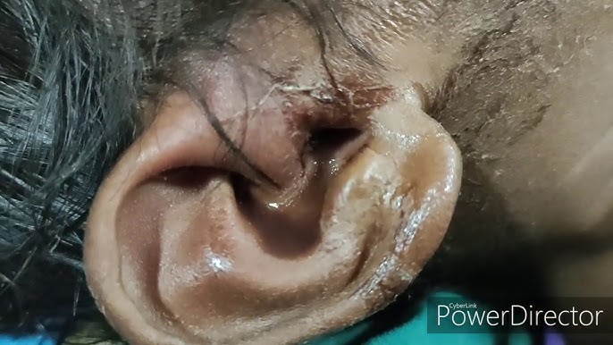 Maggots in ear, Endoscopic removal