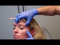 Using Filler in the Temples for a More Youthful Facial Shape
