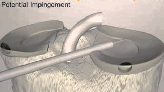 FAST FIX 360 Portals Animation - BMT Medical Devices