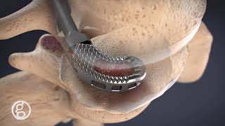 Medical Device Marketing Demo Reel - Ghost Medical Animation