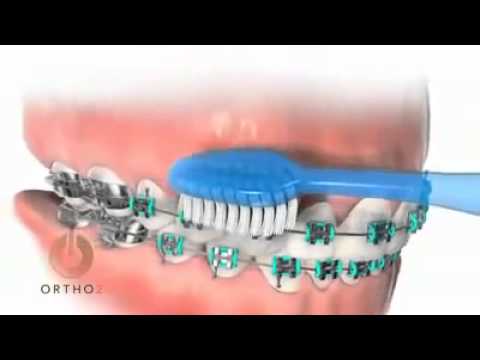 Ortodontik diş fırçalama tekniği ALPDENT Dental Group