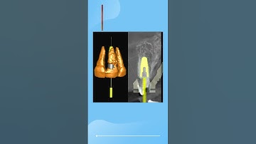 Make sure the buccal bone is safe and secure with the socket shield technique.