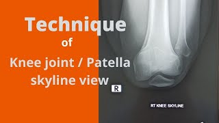 Skyline view knee/patella (Ep-41) | knee joint skyline view | patella skyline view