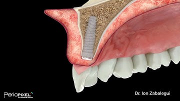 3D dental video - Compensating Alveolar Socket Seal - Trailer