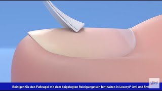 Loceryl Nagellack Gegen Nagelpilz Anwendung