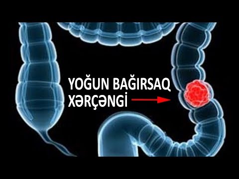 Video: Pişiklərdə Mədə Və Bağırsaq Xərçəngi (Leiomyosarcoma)