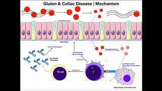 GLUTEN! Mechanisms of Celiac Disease and Gluten Sensitivity